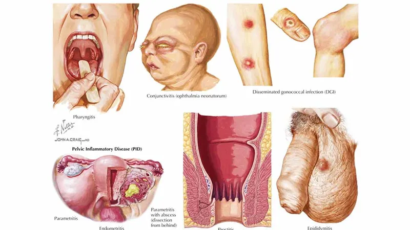 Hình ảnh của bệnh lậu ở nam giới 12