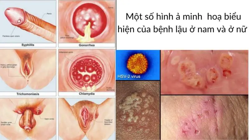 Hình ảnh của bệnh lậu ở nam giới 14